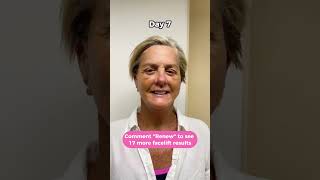 Facelift before after 18 days in pictures Facelift recovery [upl. by Akirea]