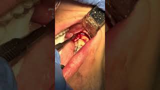 Surgical extraction of impacted wisdom tooth with reflection of flap removal of bone amp sectioning [upl. by Vharat73]