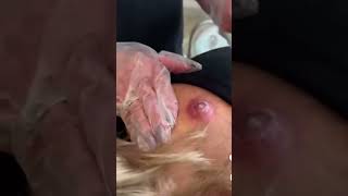 Pimple Popping Ingrown Hair Removal amp Blackhead Extractions  Ultimate Skincare [upl. by Hilly]