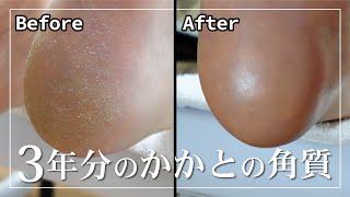 【一生取れる角質】フットケアでつるつるになりました！後編角質除去フットマッサージネイルケア [upl. by Webster]