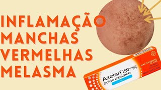 Ácido Azelaico para peles sensíveis com acne melasma e manchas vermelhas 🙌🏻 [upl. by Llecram699]