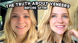 What They Dont Tell You About Getting Veneers Pain Cost Is It Worth it [upl. by Airotcivairam]