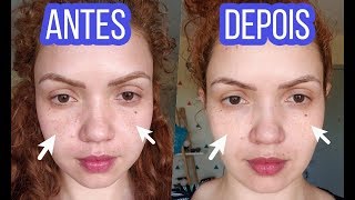 MELASMA NO ROSTO  COMO TRATAR MELASMA  UM MÊS DE TRATAMENTO minha experiência [upl. by Enelav]