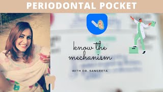 periodontal pocket carranza [upl. by Jacinto]