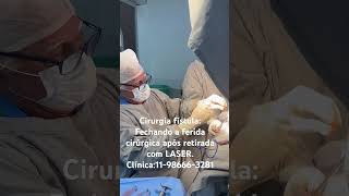 Dr Paulo Branco fazendo cirurgia fissura c 37 anos de experiência a Laser c anestesia local [upl. by Kerat]