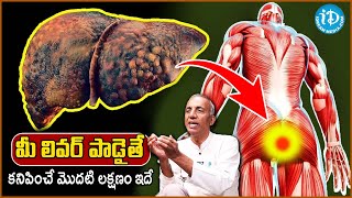 10 Symptoms of Liver Problem  Fatty Liver Symptoms  liver damage Sign  Prakruthi Vanam Prasad [upl. by Koblas]