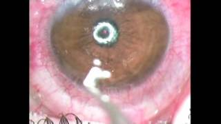 Intracorneal ring implantation  Supplementary video 26118 [upl. by Herrle]