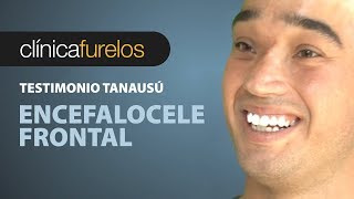 Tanausú Cirugía craneofacial Encefalocele frontal [upl. by Eronel]