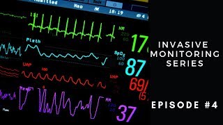 Invasive Monitoring Series Episode 4 Stroke Volume Variation [upl. by Oinesra115]