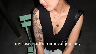 Laser Tattoo Removal in NYC Session 1 [upl. by Estell]