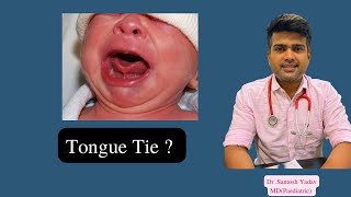 Tongue tie in baby by Dr Santosh Yadav [upl. by Lerej]