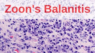 Zoons Balanitis  Pathology mini tutorial [upl. by Immot]