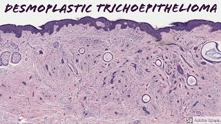 Desmoplastic Trichoepithelioma 5Minute Pathology Pearls [upl. by Gilpin]