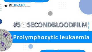 50SecondBloodFilm Prolymphocytic leukaemia [upl. by Polky]