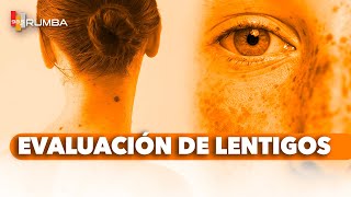 quotRevisión de Lentigos ¿Es Solo un Lentigoquot [upl. by Anikram937]