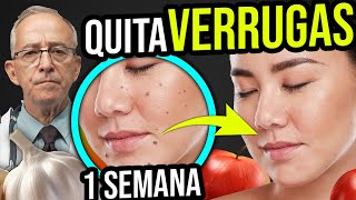 🧄 ELIMINA VERRUGAS Con Estos INGREDIENTES Y Tratamientos  Oswaldo Restrepo RSC [upl. by Felike]