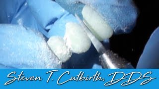 How to Fabricate Temporary Veneers  Dental Minute with Steven T Cutbirth DDS [upl. by Eleph]