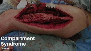 Emergency Medical Treatment Compartment Syndrome [upl. by Nasas]