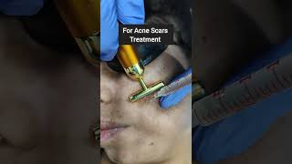 You MUST Watch PRP Therapy for Scars acnescarremoval [upl. by Illib723]