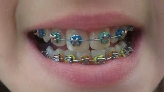 Brackets Paso a Paso  Ma01rp [upl. by Anceline]