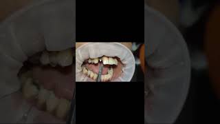 Upper lateral incisor compressive bioline implant tapping test after 6 months shorts [upl. by Ziana]