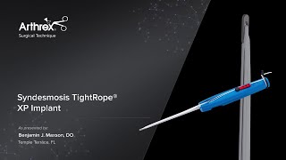 Syndesmosis TightRope® XP Implant [upl. by Bashemath]