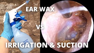 Water Irrigation And Suction Used To Clear Ear Wax [upl. by Nilek252]