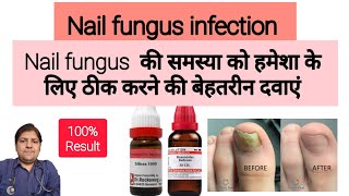 homeopathic medicine for Nail fungusHomeopathy Medicine nail problem trending youtube viralvideo [upl. by Thayer]