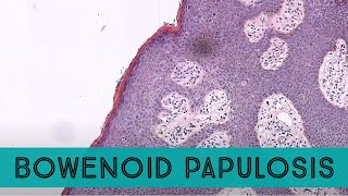 Bowenoid papulosis HSIL high grade squamous intraepithelial lesion high risk HPV dermpath [upl. by Miranda]