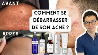 PEAU SANS ACNÉ  BOUTONS BLANCS OU ROUGES MICROKYSTES PLAQUES DE BOUTONS PAPULES PUSTULES [upl. by Yras544]