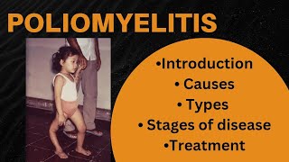 Poliomyelitis  Introduction Causes Stages of poliomyelitis diagnosis Treatment [upl. by Aeslek]