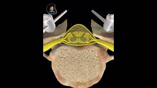 Laminectomy with lateral mass screw fusion [upl. by Enicnarf17]