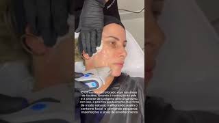 Aplicação UltramedUltraformer facial  Ultrassom microfocado [upl. by Irmina911]