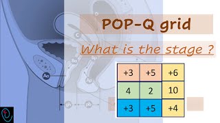 POPQ grid explained [upl. by Atinek]