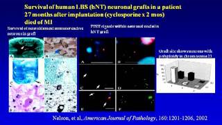 Stem Cell Therapy for Stroke  Gary Steinberg Stanford University [upl. by Ecirpak658]