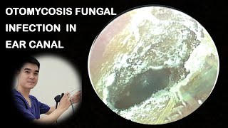 OTOMYCOSIS FUNGAL INFECTION IN EAR CANAL amp EAR WAX REMOVAL HATA5 [upl. by Huberto528]