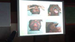 Obstructive Jaundice amp Special Focus on Choledocholithiasis amp Periampullary Carcinoma SEMINAR [upl. by Maggi]