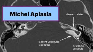 Michel Aplasia  Complete Labyrinthine Aplasia Radiology Radiology ENT Ear [upl. by Ettezus]