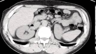 CT Bladder Diverticula CASE DISCUSSION by a Radiologist [upl. by Itsrik]