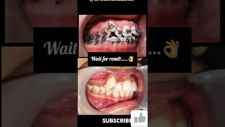 Bracess procedureshortsviralshorts orthodontistcrowded teeth 😬 Drswetakaushik aade tede daant [upl. by Irt274]