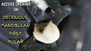 access opening on primary mandibular first molar  demo step by step [upl. by Eecyak952]