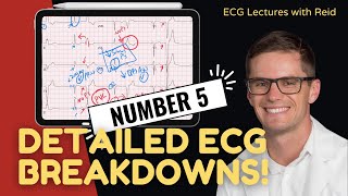 EKG Test Yourself  ECG Case Study 5 [upl. by Eiramacissej]