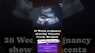 20 Weeks Pregnancy showing Placenta Previa On Ultrasound [upl. by Strohbehn]