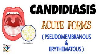 CANDIDIASIS  ACUTE FORMS  PSEUDOMEMBRANOUS amp ERYTHEMATOUS [upl. by Aerehs]