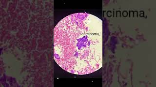 Invasive squamous cell carcinoma [upl. by Nauqaj]