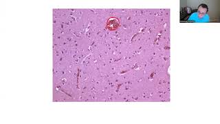 NEUROPATHOLOGY BOARD REVIEW 1 [upl. by Beck462]