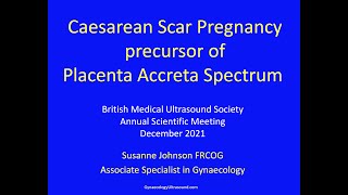 Caesarean Scar Pregnancy precursor of Placenta Accreta Spectrum [upl. by Alemahs761]