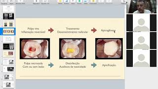 Endodontia de Dentes Decíduos [upl. by Yrallam]