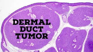 Dermal duct tumor vs poroma vs hidradenoma acrospiroma quotfamilyquot of sweat gland tumors dermpath [upl. by Einnos]