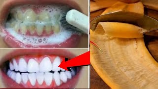 In Just 2minutes Whiten Yellow stained Teeth at Home BEST TEETH WHITENING REMEDY ll NGWorld [upl. by Shaylynn588]